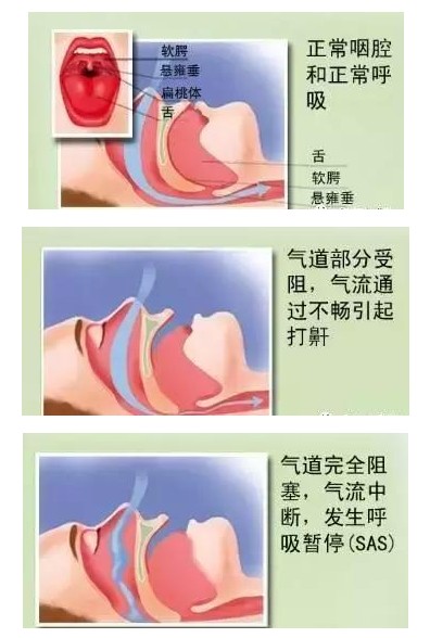 呼吸機(jī)可以完全治愈睡眠呼吸暫停嗎？